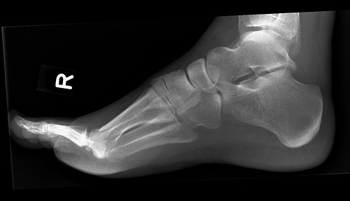 sprainedfoot